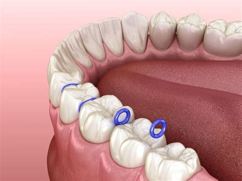 spacers for teeth before braces